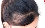 جلوگیری از ریزش مو با طب سنتی