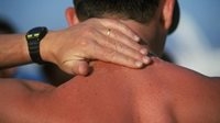 10 درمان موثر برای آفتاب سوختگی